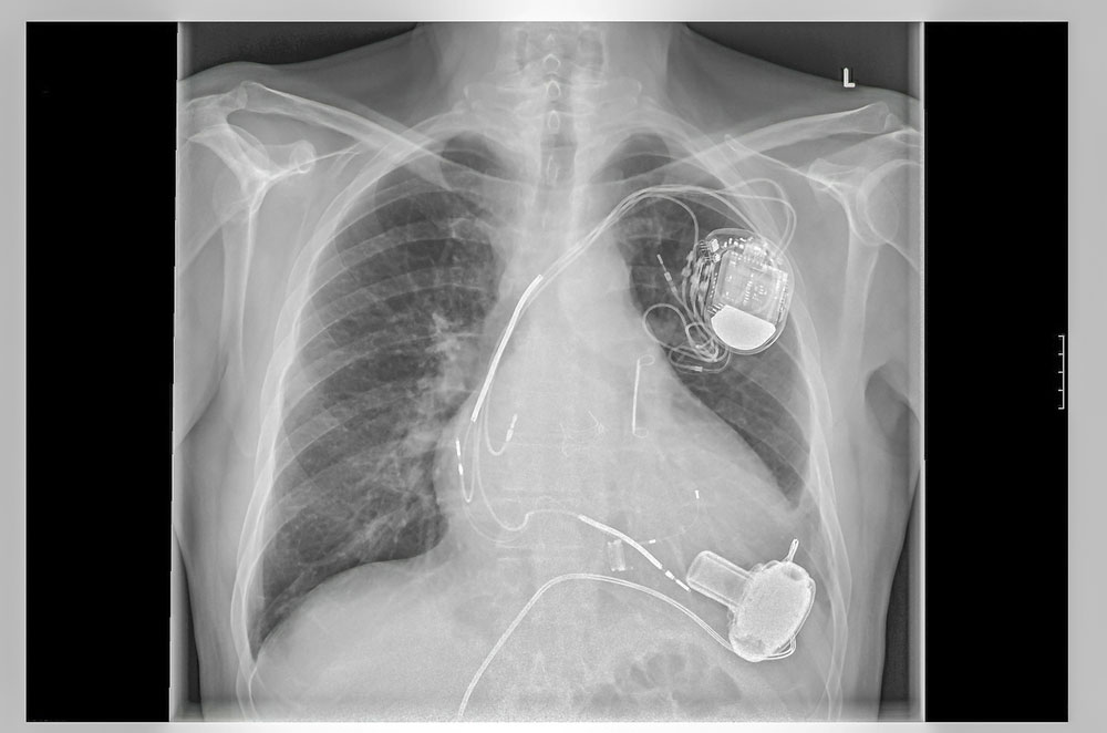 A pacemaker placement in the human body